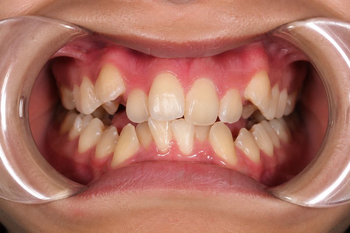 Before treatment — patient's teeth prior to treatment